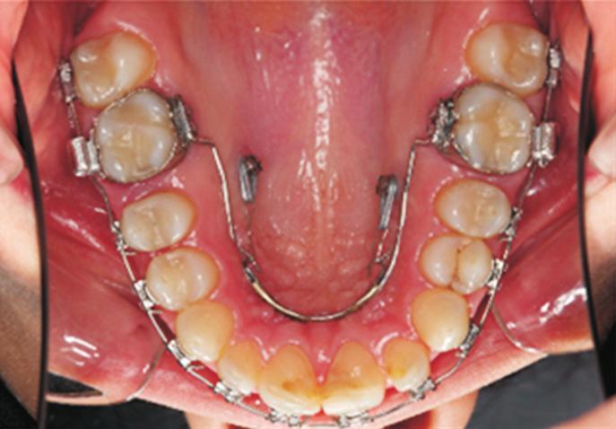 INTRODUCTION Class II malocclusion can be appraised as skeletal and dental Class II.