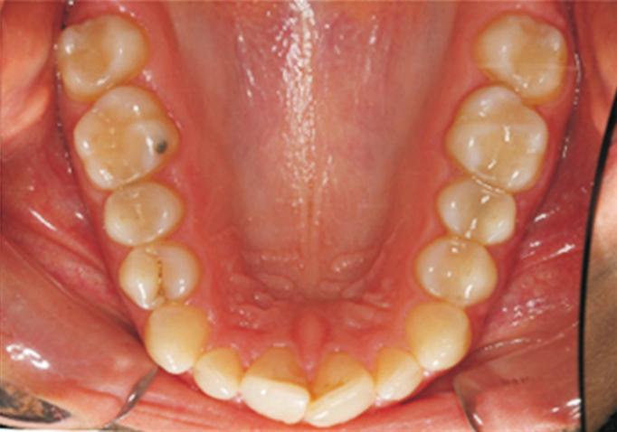 extraction of premolars or distal movement of the maxillary molars.