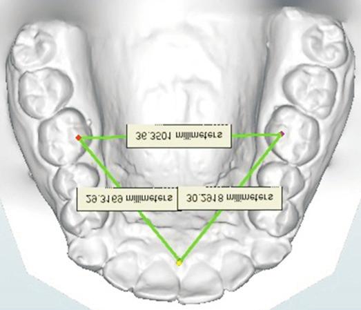 dental casts, a dentist placed two miniscrews, each with a range of 8 10 mm in length and 1.4, 1.6, or 2.0 mm in diameter in the palatal interdental area under local anesthesia.