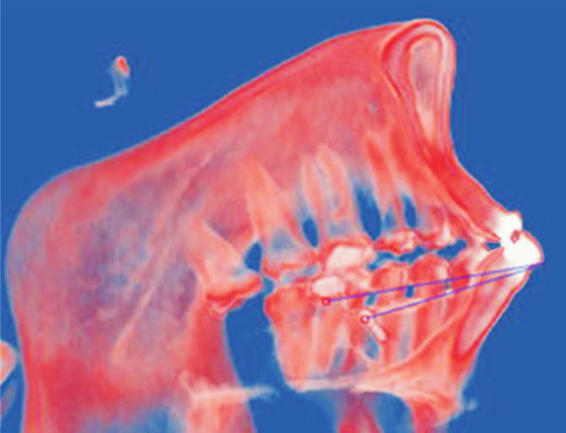 The red areas are contact areas, which are more marked on the right first maxillary molars before treatment than after treatment.