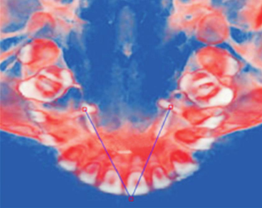 Demonstrations of the lines of traction force by cone-beam computed tomography (CBCT) images. A, Right sagittal view; B, left sagittal biew; C, coronal view.