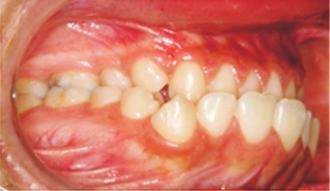 A B C Figure 5. The sequence of changes in dentition.