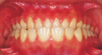 the maxillary molars showed relative molar intrusion that