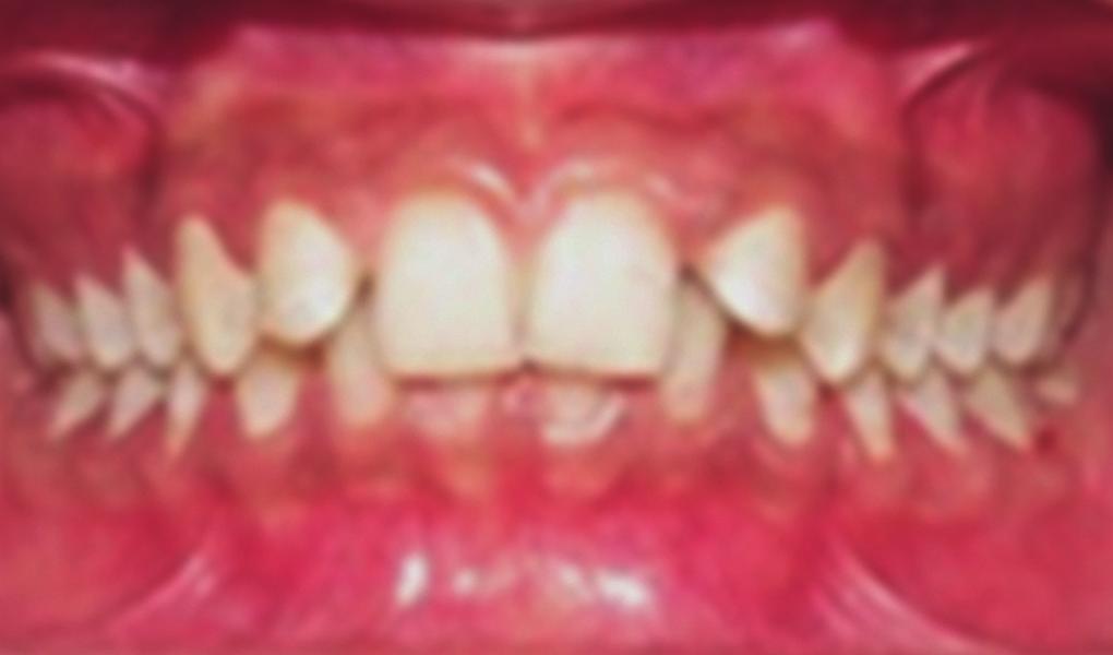 division 2 malocclusion, with