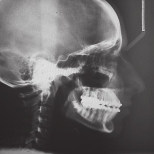After achieving the leveling and alignment within seven months and transpalatal arch placed in maxillary arch for reinforcement of anchorage. 0.019 0.