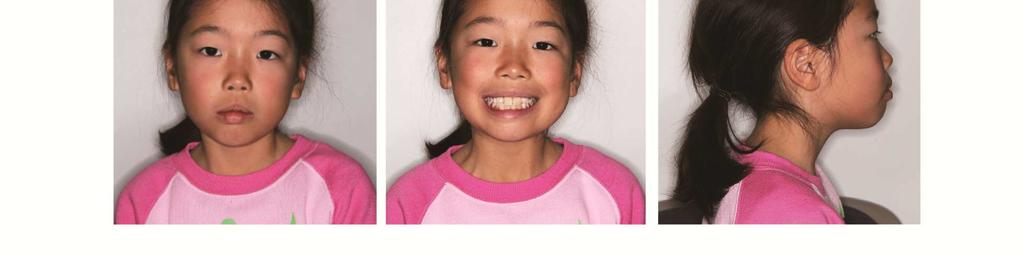 Her face was symmetric from the frontal view and her smile line was good, but her profile was convex because of upper lip protrusion and mandibular retrognathism.