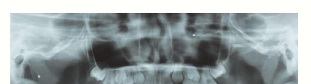 The panoramic radiograph did not show tooth germs of the bilateral mandibular third molars (Figure 8). The lateral cephalometric radiograph showed an SNA angle of 85.0, an SNB angle of 76.