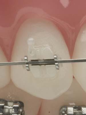 Bracket Positioning Benefits: Visual References Accuracy of bracket positioning is essential, so that the prescription of the bracket can be expressed.