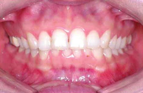 the maxillary central incisors by approximately 6 mm while tipping them 25 o labially, without causing infection,