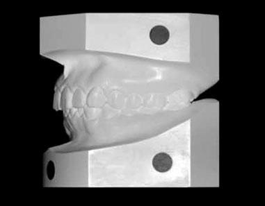 Figure 2. Pretreatment dental casts. 1).