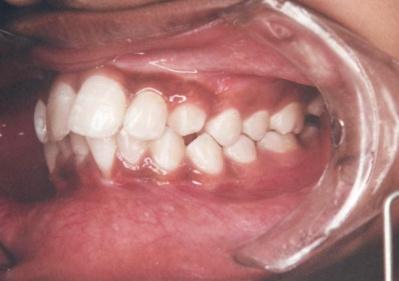 crowded upper and lower teeth,