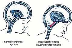 CLASSIFICATION OF HYDROCEPHALUS Aqueductal stenosis...43% Hydrocephalus caused by narrowing of the aqueduct of Sylvius (4th ventricle outflow).