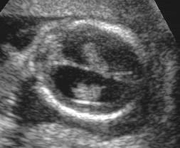 Chapter 5: Fetal Central Nervous System 85 1st trimester: CSF seen in lateral ventricle totally surrounding and compressing choroid plexus.