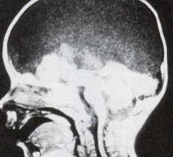 (arrow), dependent choroids. Hydranencephaly Total or near total absence of cerebral hemispheres with normally developed meninges and skull.