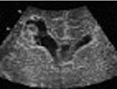 PORENCEPHALY The presence of cystic areas within the cerebral parenchyma.