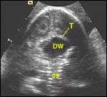 large midline cystic structure in posterior fossa which is enlarged 4th vent. Enlargement of posterior fossa.