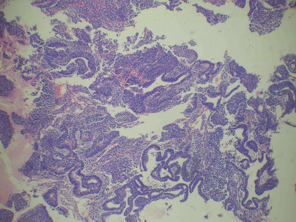 Between the tumor cell aggregates, delicate fibrovascular septa were observed. There was focal extensive necrosis in the immature teratoma component. Vascular permeation was easily found.
