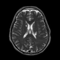 MRI Brain Imaging Techniques Structural