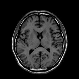MRI Brain T1-weighted image Adipose tissue, blood products or proteinacious fluid will