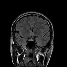 MRI Brain FLAIR (Fluid Attenuated Inversion Recovery)