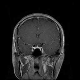 MRI Brain Post-contrast T1-weighted image Normal brain tissue will not