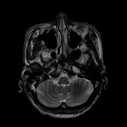 MRI Brain Maxillary Sinus Medulla Oblongata
