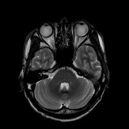 MRI Brain Pons Cerebello-pontine Cistern 4 th Ventricle Temporal