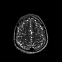 MRI Brain Frontal Lobe Falx Cerebri Pre-central Gyrus (motor