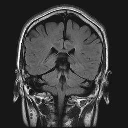 MRI Brain Falx Cerebri Parietal Lobe