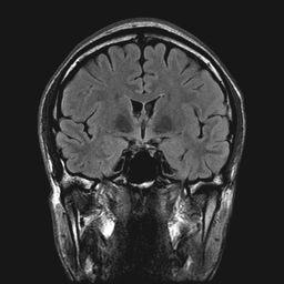 MRI Brain Longitudinal Fissure Lateral