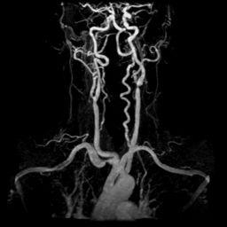 MR Angiography (MRA) Extra-cranial carotid and vertebral