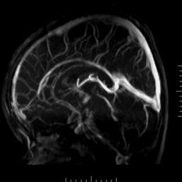 MR Venography (MRV) Superior Sagittal Sinus