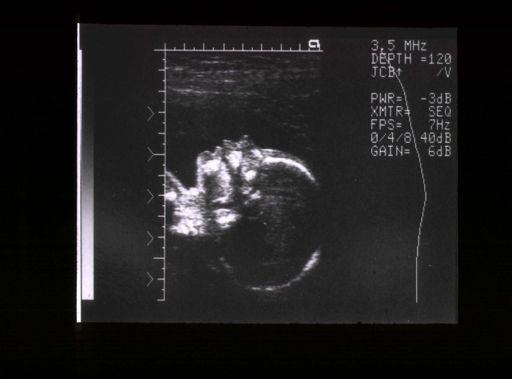 Fetal MR Imaging MRI is a valuable complement to obstetric ultrasound