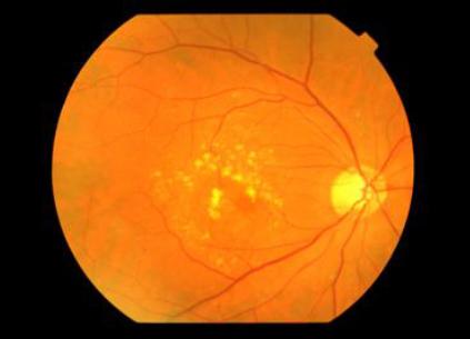 Drusen are yellow spots or deposits under the macula which gradually enlarge with time. Large drusen can damage the light receptor cells of the macula leading to gradual worsening of central vision.