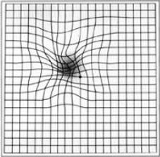 Distortion of central vision detected on an Amsler grid What can we do to prevent Dry AMD?