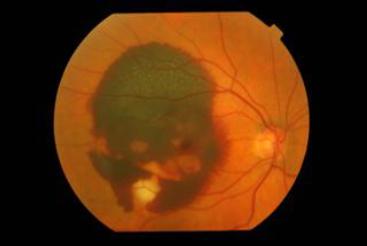 Wet AMD - Sudden Bleeding at the Macula What will your Ophthalmologist do if Wet AMD is suspected?