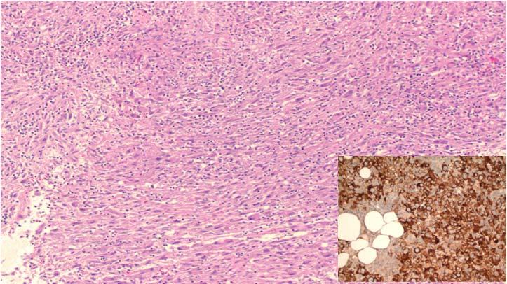 Angiomyolipoma Mesenchymal tumor that is part of a family of tumors known as PEComa (perivascular epithelioid cell).