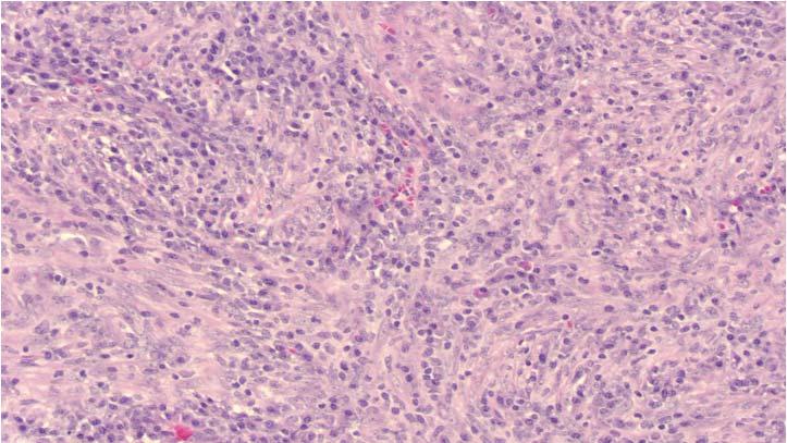Myoid cells can be spindled to epithelioid, and stain with muscle markers (desmin, SMA) as well as melanoma markers (HMB-45, melan-a) Uncommonly, they can have an inflammatory component, usually