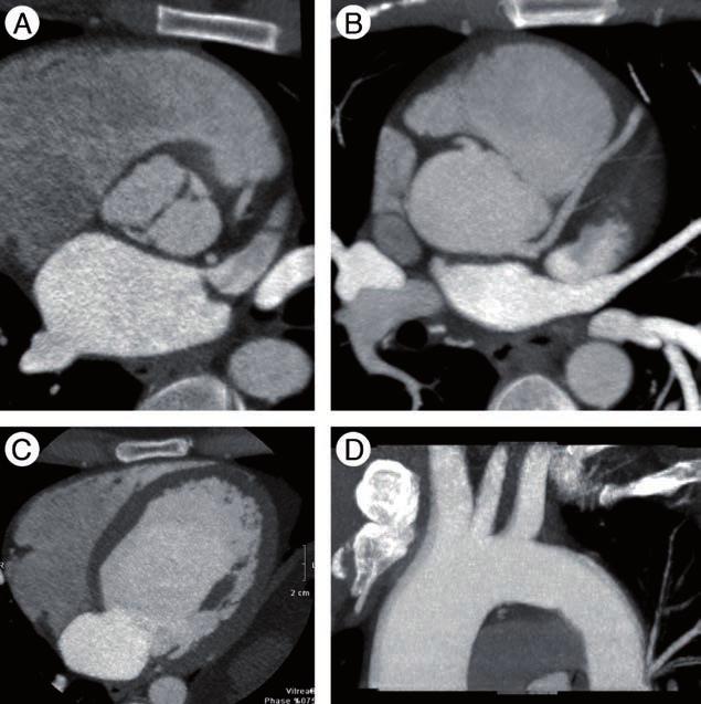 Recent developments in cardiac CT REVIEW of main pulmonary artery, RV hypertrophy and interventricular septum deviation towards the left.