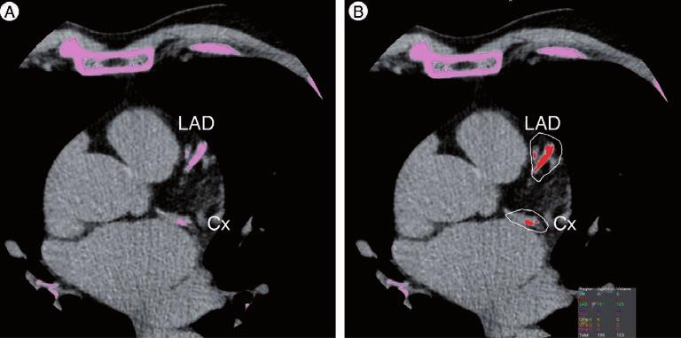 Recent developments in cardiac CT REVIEW LAD LAD CX CX Region Agatston Volume LM RCA 0 0 0 0 LAD 161 125 CX 34 28 PDA Other 1 Other 2 Other 3 0 0 0 0 0 0 0 0 Total 195 153 calcium mass [22].