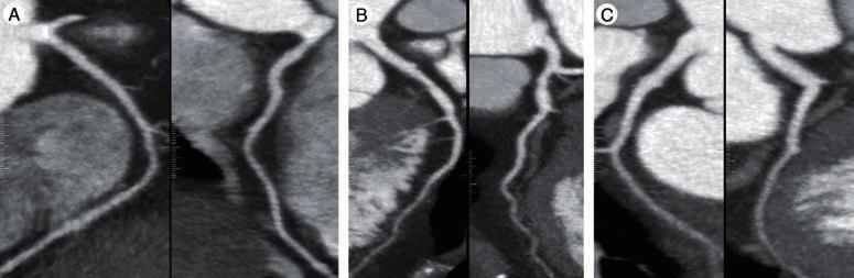 REVIEW van der Bijl, Geleijns, Joemai et al. Figure 2. Coronary CT angiography for a 56 year-old female patient with atypical chest pain and inconclusive stress-test.