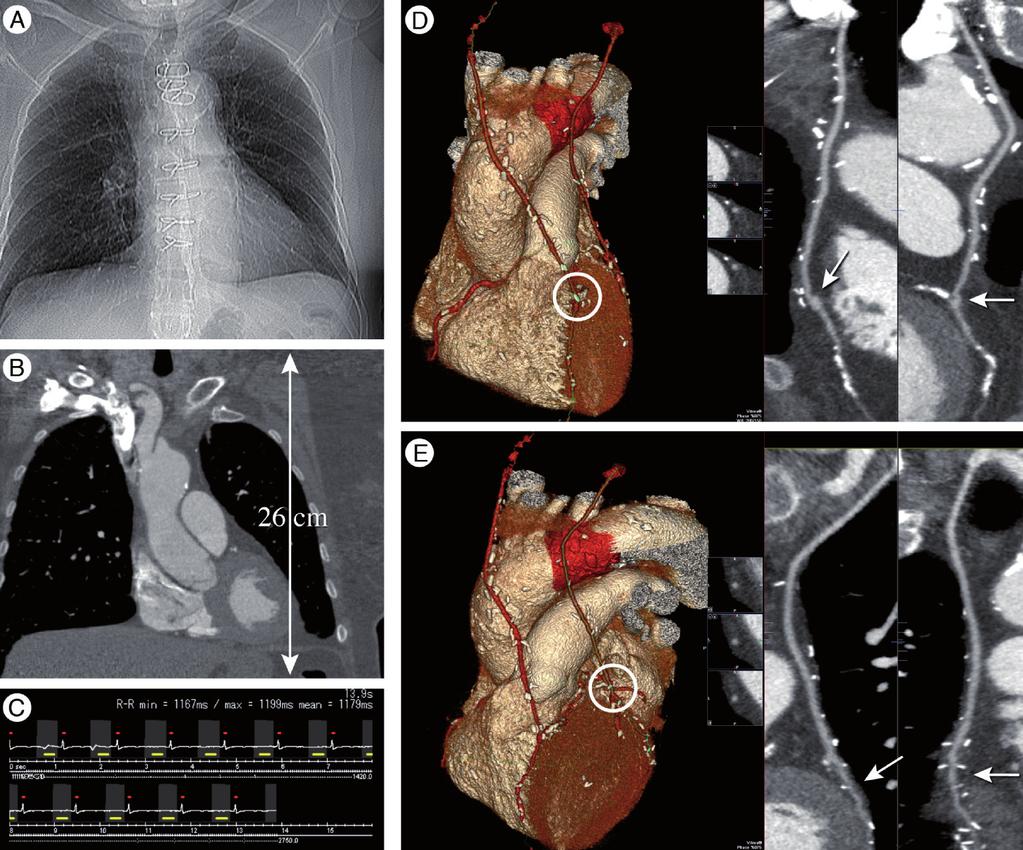 Recent developments in cardiac CT REVIEW 26 cm Figure 3. Coronary artery bypass graft evaluation for a 74 year-old female patient with coronary artery bypass grafts and recurrent chest pain.