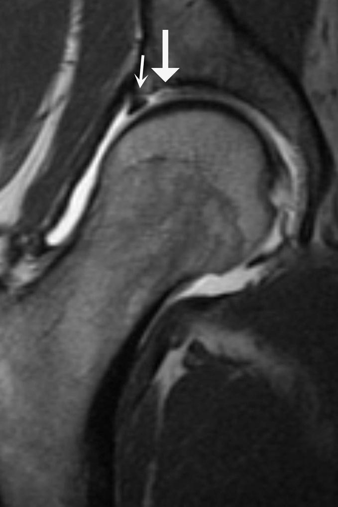MRI with Arthrogram MRI done with an injection is the best type of imaging that we have now.