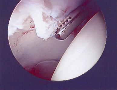 The Problem with CAM FAI CAM type of FAI can injure the cartilage when it tears the labrum Sometimes, the cartilage of the Cup can peel off of the