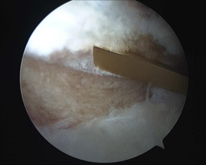 Labrum intact for this step when possible