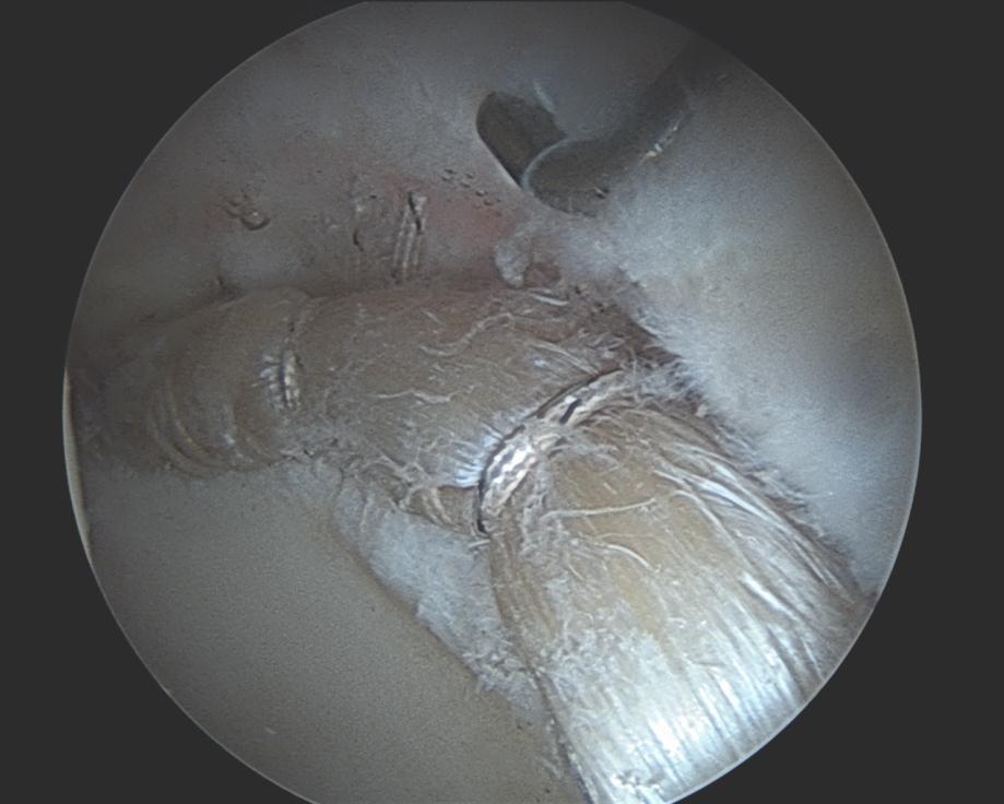 Labral Reconstruction I can make a New labrum from Cadaver Graft. Everything is done arthroscopically.