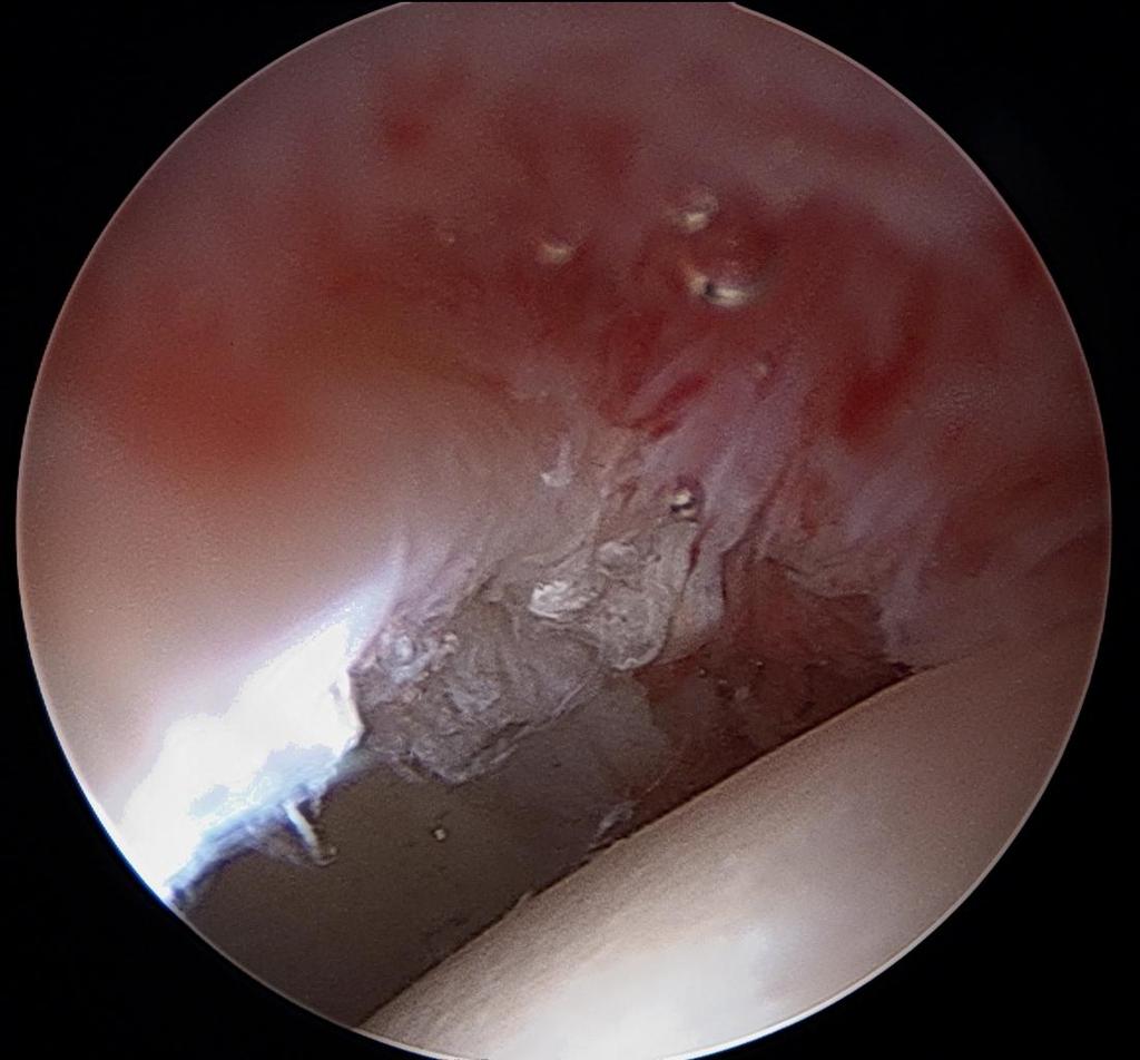 Labral Reconstruction *Labrum Not repairable Reconstructed
