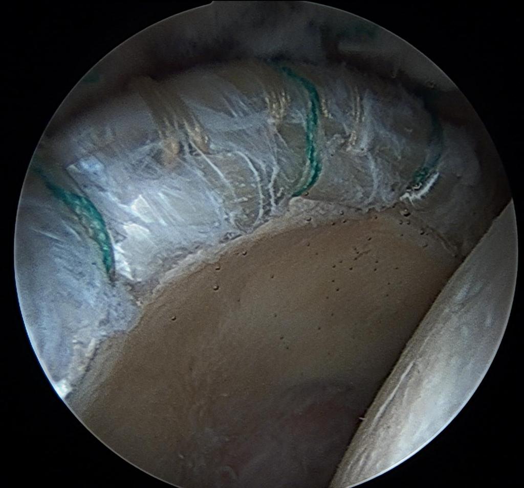 labral tissue can be replaced with a graft that can