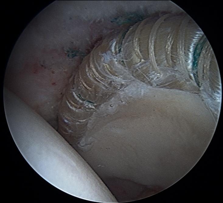 New labrum Labral Reconstruction Ball Cup Seal between the labral graft