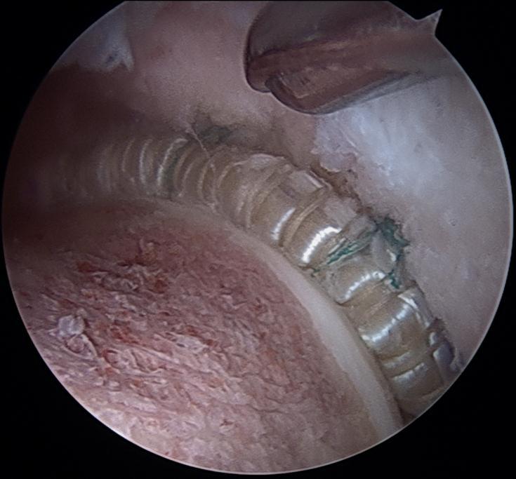 labrum Graft can never be painful Ability to reproduce normal anatomy